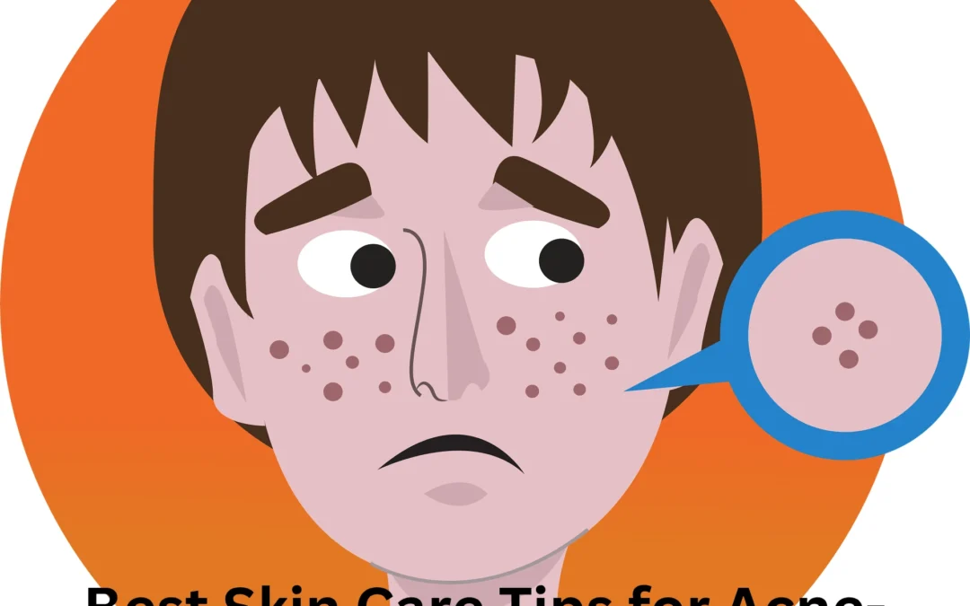 Best Skin Care Tips for Acne-Prone Skin